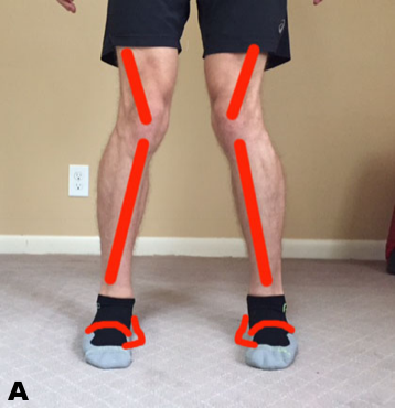 Assessing the Lower Half: Recognizing Muscular Imbalances Through Postural Assessments