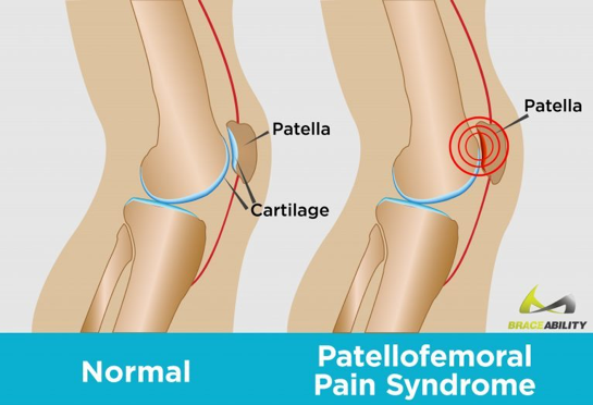 Runner’s Knee (Patellofemoral Pain Syndrome – PFPS)