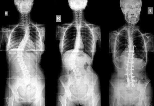 Scoliosis – Adapting to a Skeletal Abnormality